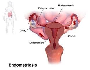 tatizo la endometriosis