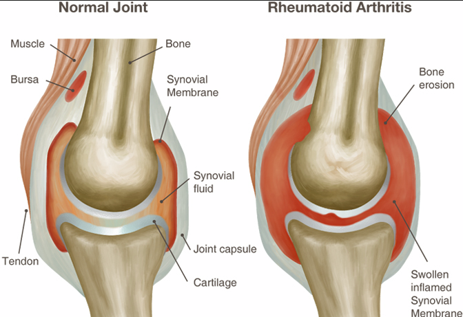 rheumatoid arthritis joint