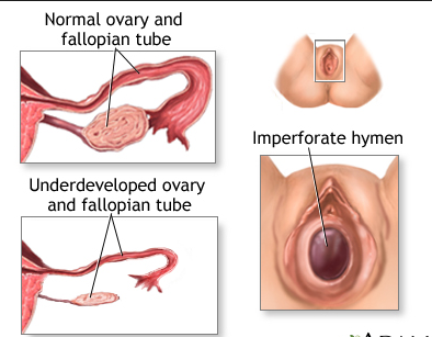 amenorrhea ovary